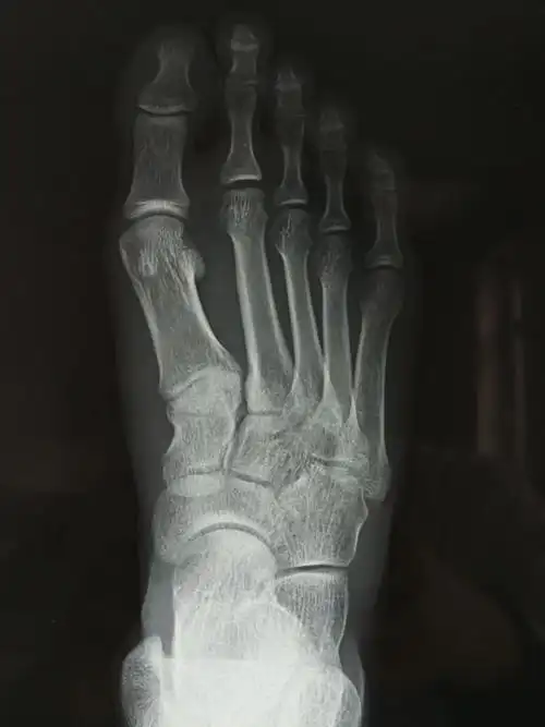 门诊拍了个片子,没事.没有骨折,没有脱位