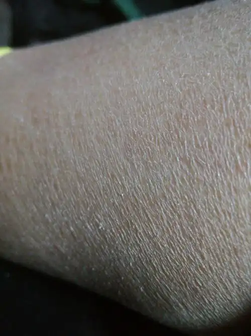 遗传性的皮肤干燥手上全是死皮脚上也是一到冬天脸就脱皮腿上也是