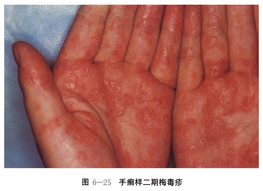 性病科普:得了梅毒多可怕?(有图,慎点)