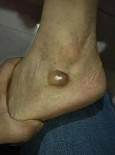 我爸脚背上长了个肉瘤,他说有好几年,但今天才告诉我!