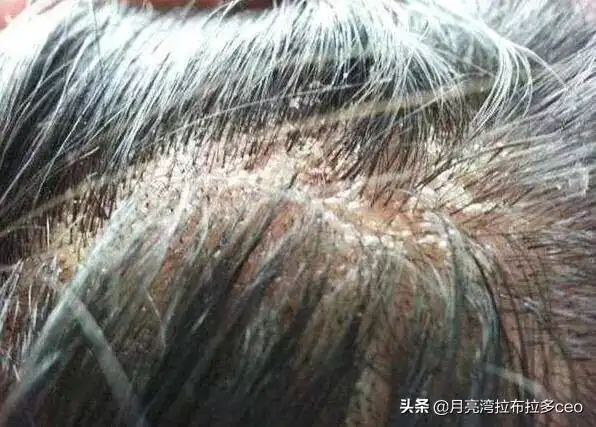 头发有螨虫,很油腻,掉发厉害,用硫磺皂可以恢复头发的健康吗?