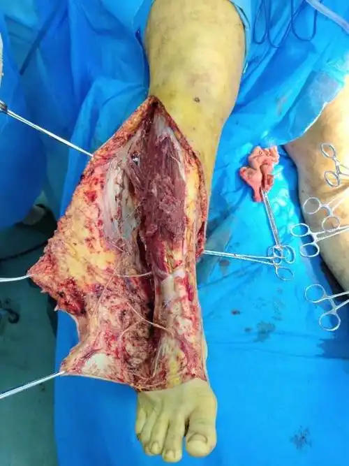 及手术治疗,患者中年女性因交通肇事被大型车辆碾压导致双下肢碾压伤