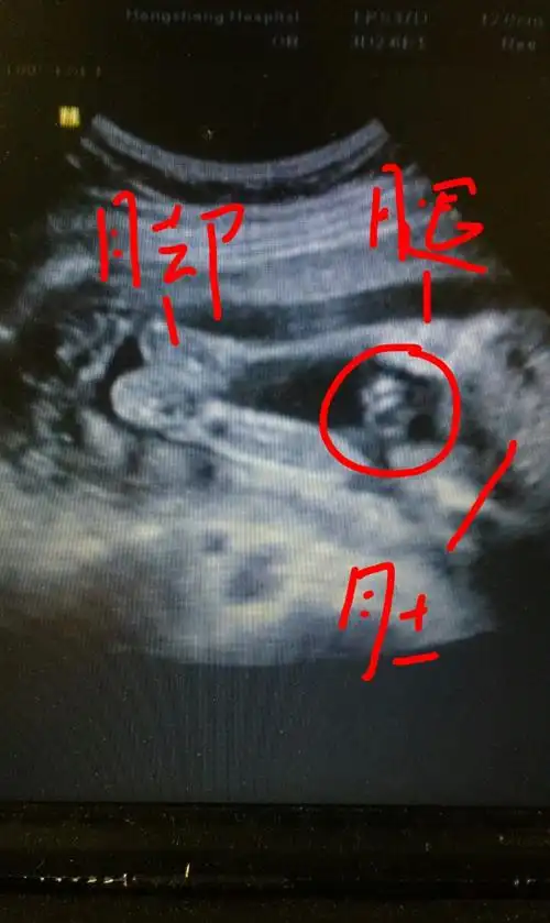 四维彩超,两次发现貌似蛋蛋的两个对称的东西,中间间隔几分钟,再看