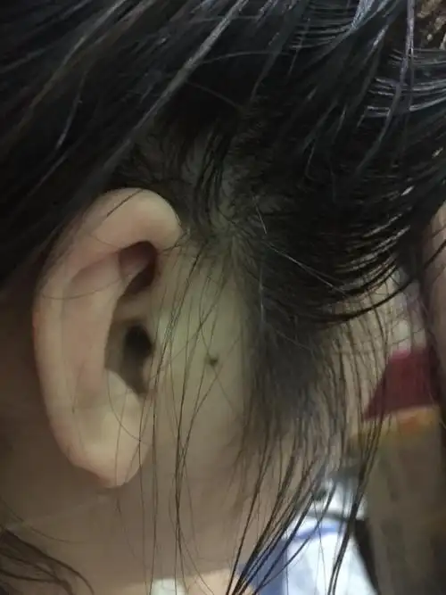 右耳耳屏旁边有颗痣,从面相学来说,这代表什么意思?