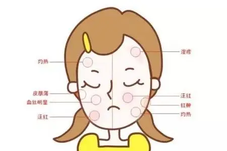 复方醋酸地塞米松乳膏治疗面部湿疹安全吗?