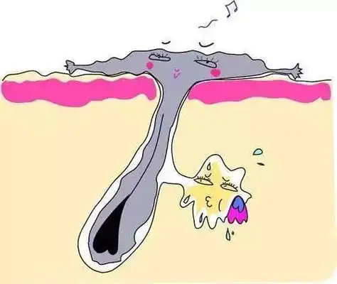 其实,毛孔堵塞会引起毛孔粗大,痘痘,粉刺等等一大堆肌肤问题.