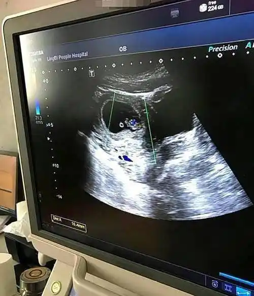 b超检查是男宝,宝爸盼女儿希望翻盘,为啥医生说有点困难?