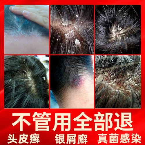 头癣银屑癣毛囊炎专用药头部外用头皮真菌克星抑菌乳膏皮囊炎药膏