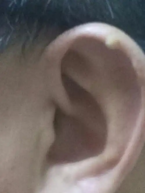 问一下耳朵长的白色的这个是什么东西,怎么引起的,怎么消除呢?