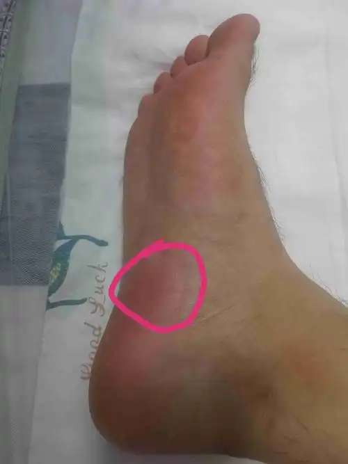 右脚脚心和脚跟之间疼