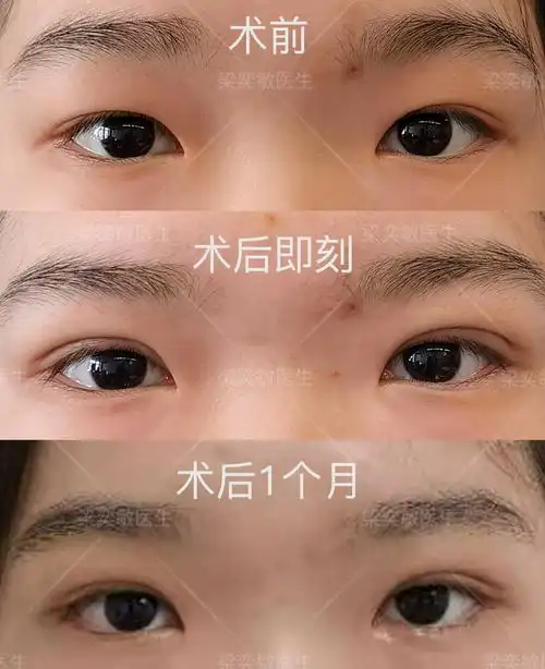 埋线双眼皮术后1个月