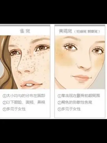 色斑是因皮肤黑色素的增加而形成的,面部呈褐色的黑色素沉着的皮肤