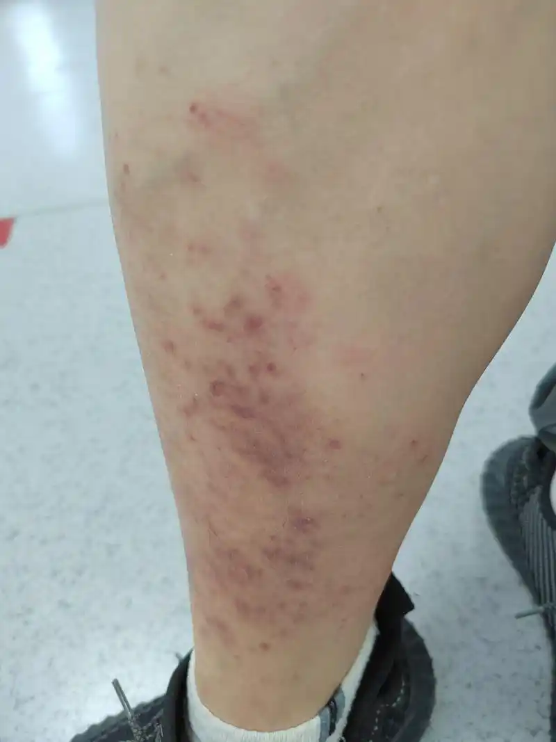 小腿部位的红斑丘疹症状.考虑夏季皮炎.