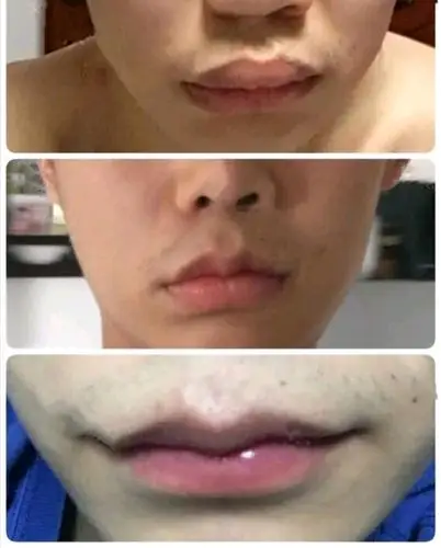 做上唇改薄,天生上唇比较厚,加上以前比较爱咬嘴唇,_圈子-新氧美容