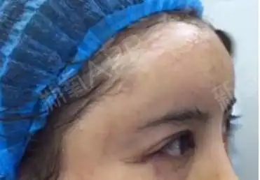 全脸脂肪填充失败图片好后悔,脂肪填充五年后遗症,都_圈子-新氧美容