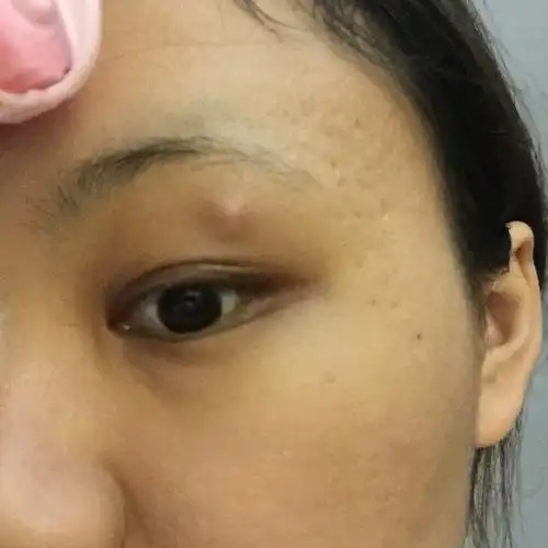 眼皮上方长了一个疙瘩 不痛不痒 两个礼拜左右了 4-5mm 请问这个要去