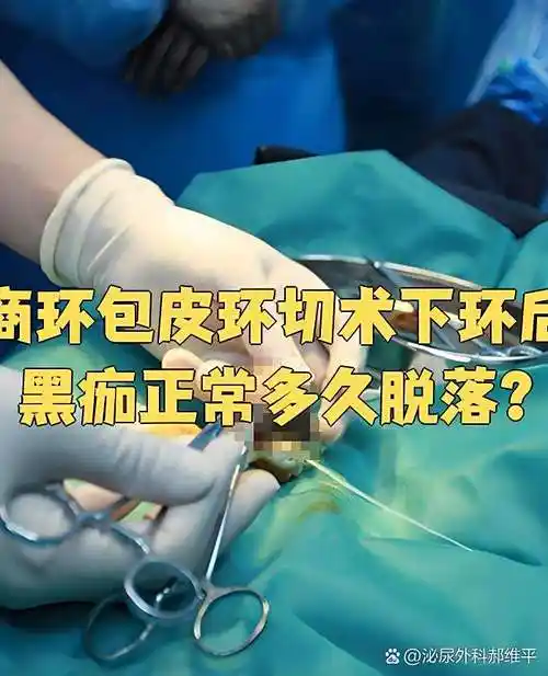 商环包皮环切术下环后黑痂正常多久脱落?