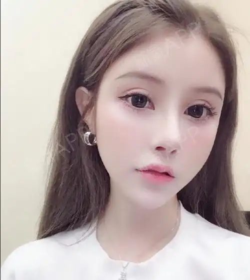 双眼皮割得比较宽的哈!