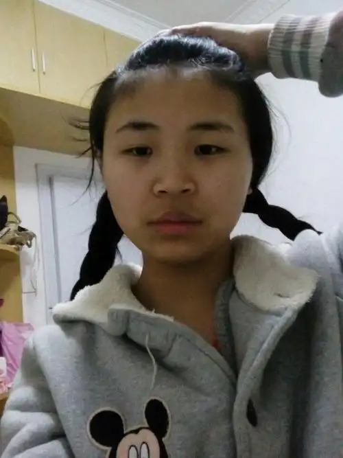 可以告诉我大饼脸是什么样的吗?我小时候脸没有这么圆,现在可以瘦脸吗