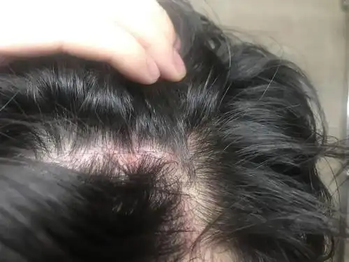 头皮上能摸到的"小疙瘩",到底是什么?会影响健康吗?