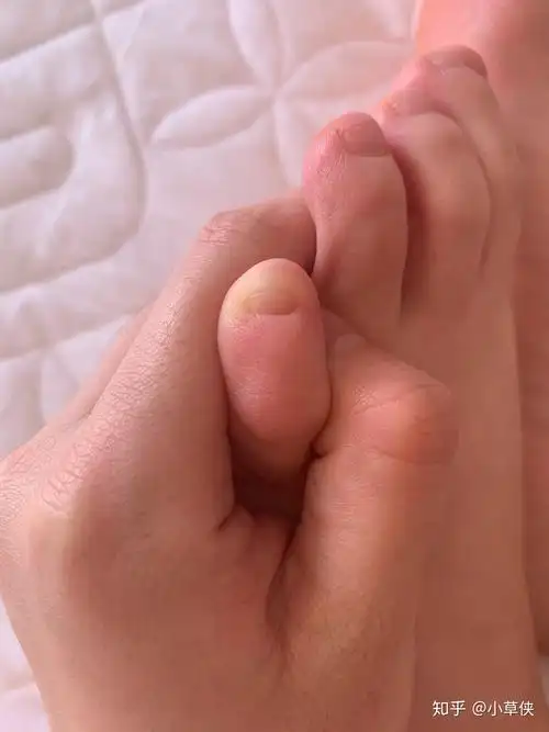 小脚趾的指甲特别难看怎么办