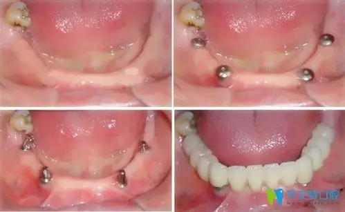 即刻种植牙的真人案例效果图