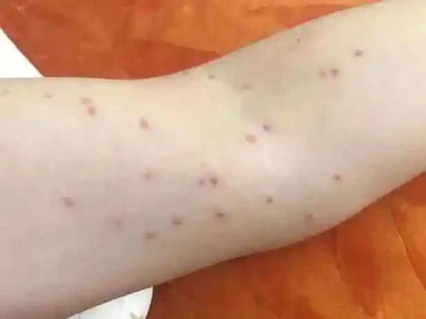 皮肤科 21 种常见病大盘点!