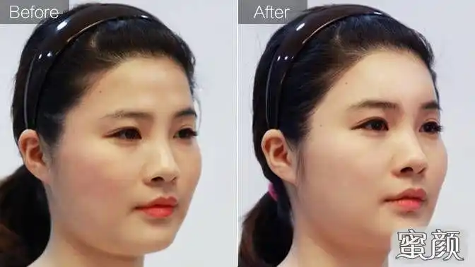 美然纠结用韩士生科硅胶还是菲思挺膨体填充天生的窄额头