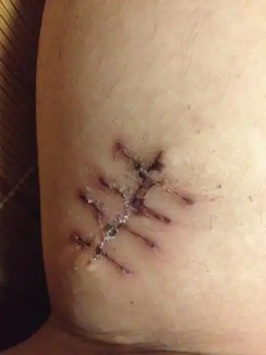 问:门诊手术刀疤恢复成这样算可以吗