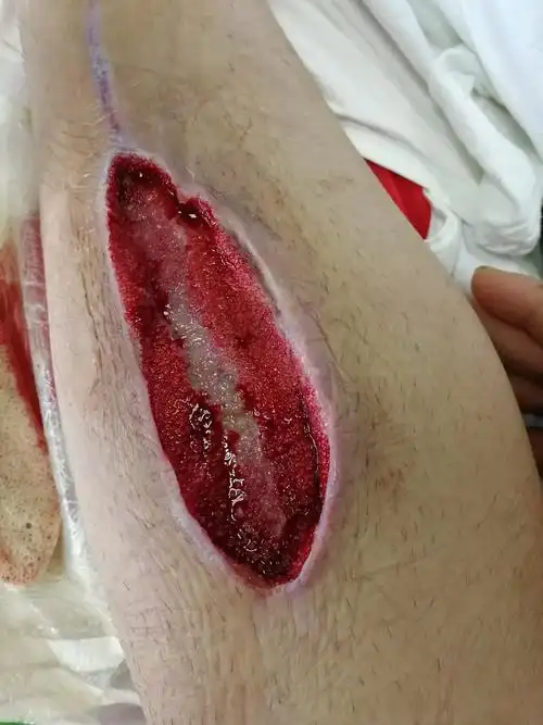 用新理念告别烂伤口