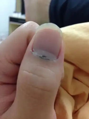 手指甲根部发黑为什么