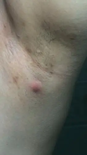 腋下这个是毛囊炎还是淋巴结肿大有图