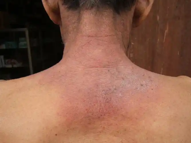 看图会诊是否为日光性皮炎