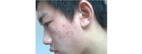 脸颊有黑头粉刺?7天黑头粉刺全去除!