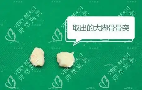大脚骨手术是切除骨头吗?分情况拇外翻手术过程图解给公布!