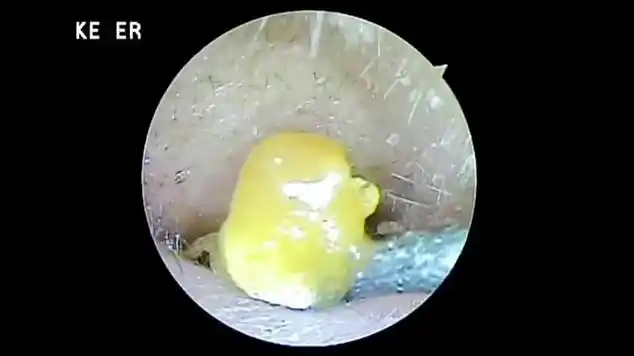 又是一个油耳朵,你知道这种油耳朵是如何形成的吗|医学科普|外科学