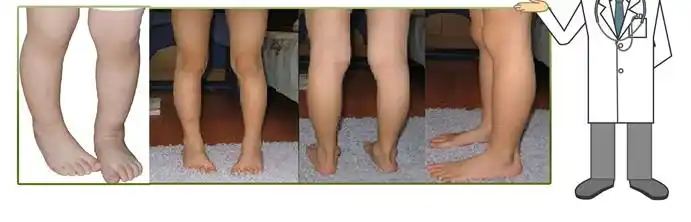 内八字的基本信息