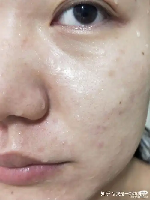 三角区还有下巴 有时瘙痒然后运动了脸就会发红 可能是角质层太薄了