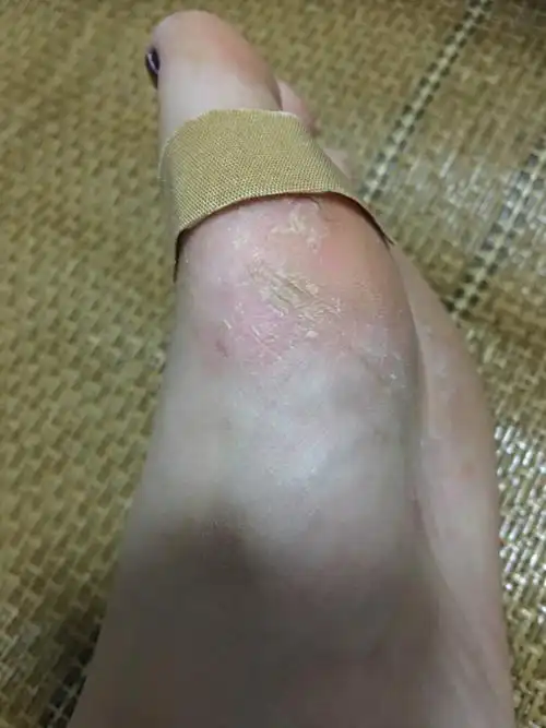 脚底恶心死了 将近快半个月了,我现在怀孕七周多点 达克宁涂了也不见