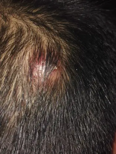 头上长了毒疮有浓了要不要挤出来 现在就是拿纸巾