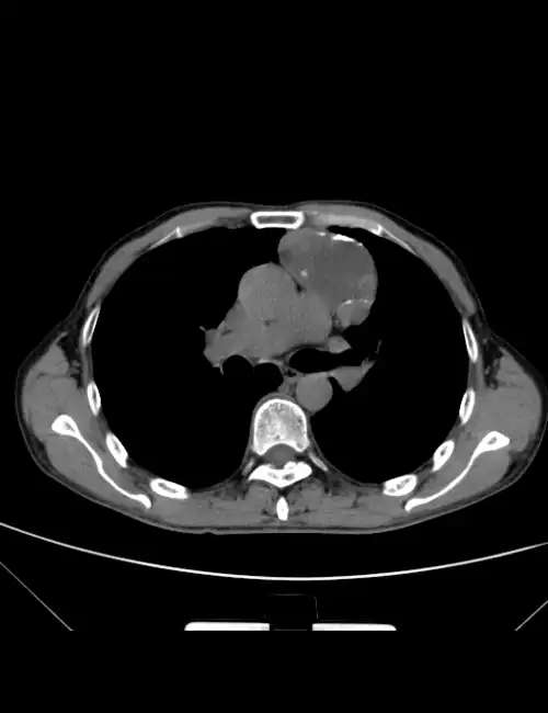 胸部ct平扫图片金典