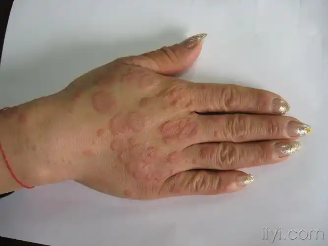 看图识病 - 皮肤及性传播疾病讨论版 - 爱爱医医学论坛 - 爱爱医医学