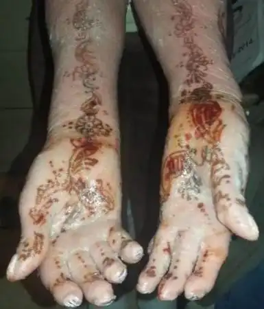 女子患有鱼鳞病每天如蛇一样脱皮