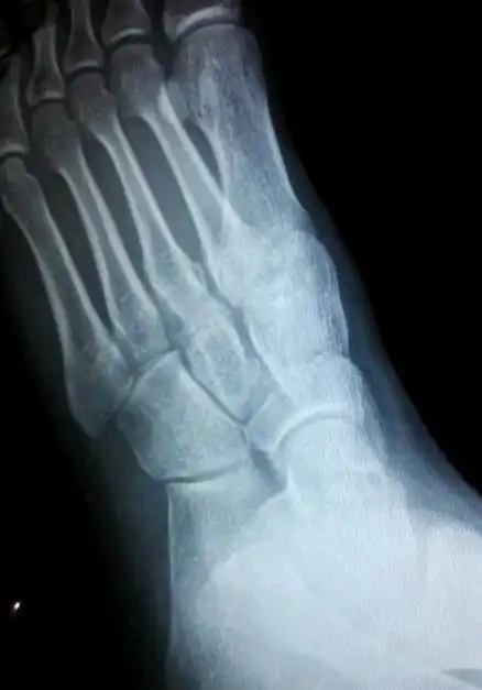 足骨骨折多久能好