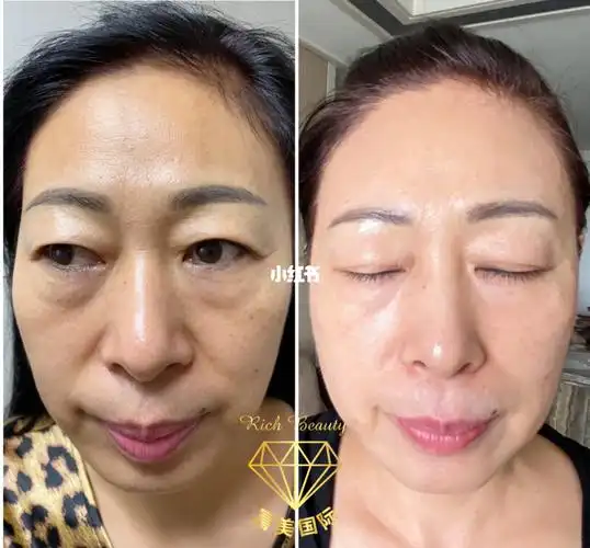 钻石面膜前后对比图_钻石面膜_美妆_护肤_面膜