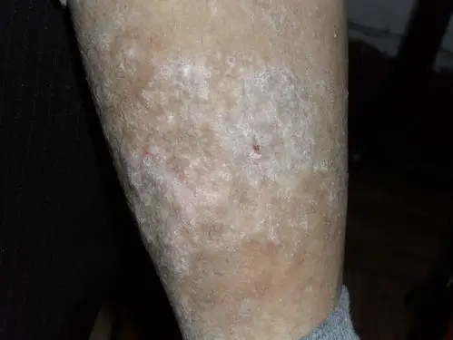 小腿上有一片和癣一样的东西,不是很痒,多年未愈.