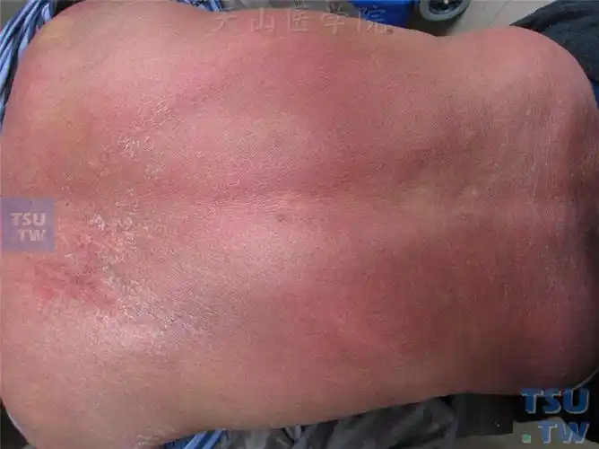 皮肌炎dermatomyositis的症状表现