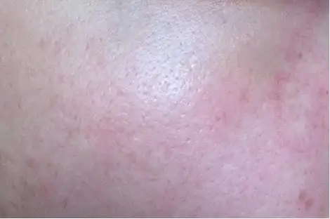 面部出现红血丝该怎么修复?