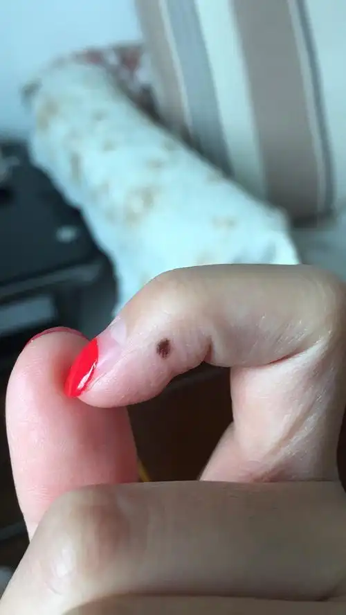 一直没有放在心上,直到前几天,右手的小指上出现了同样的黑色素痣,就