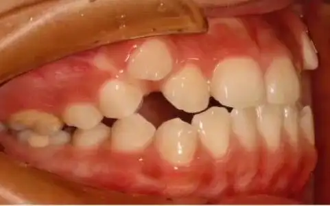 虎牙长在牙龈上面可以矫正吗